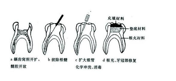 做根管治療大概要多久-成都義齒廠家