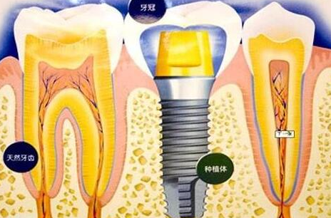 種植牙齒有什么壞處-義齒廠家