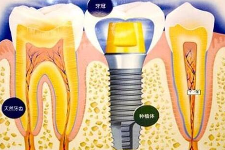 種植牙齒有什么壞處-義齒廠家