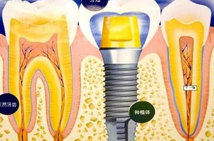 種植牙齒有什么壞處-義齒廠家