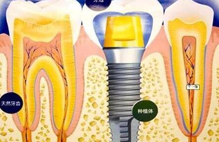 種植牙齒有什么壞處-義齒廠家