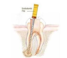 什么叫根管治療-四川義齒廠家