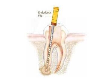 什么叫根管治療-成都義齒廠家