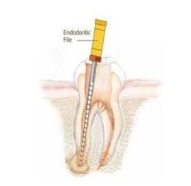 什么叫根管治療？ |  四川義齒廠家