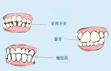 牙齒不齊會帶來哪些危害 | 成都義齒廠家